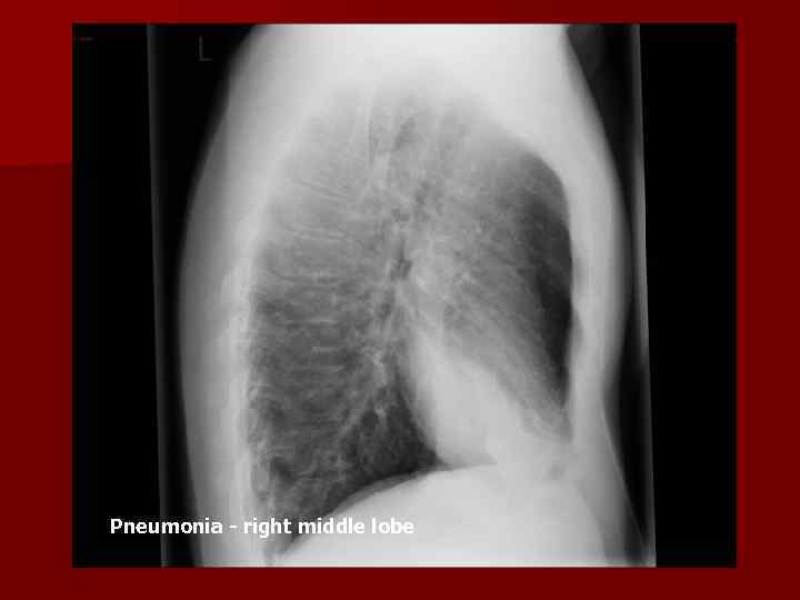 Pneumonia - right middle lobe 