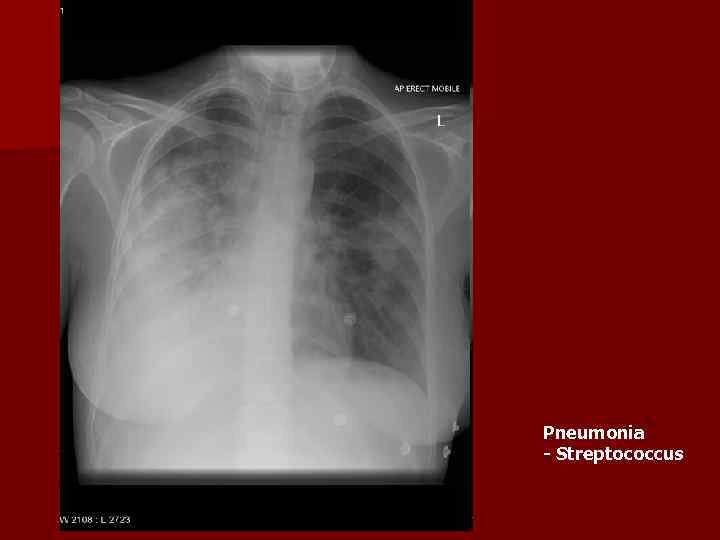 Pneumonia - Streptococcus 