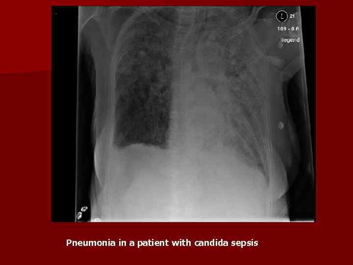 Pneumonia in a patient with candida sepsis 