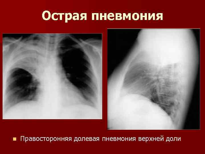 Правосторонняя пневмония