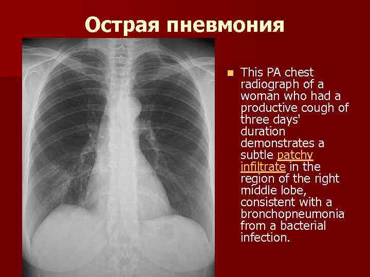 Острая пневмония n This PA chest radiograph of a woman who had a productive