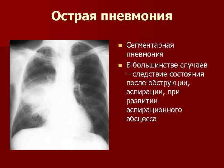 Острая пневмония Сегментарная пневмония n В большинстве случаев – следствие состояния после обструкции, аспирации,