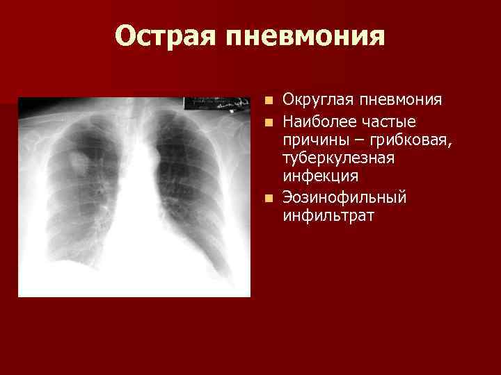 Острая пневмония Округлая пневмония n Наиболее частые причины – грибковая, туберкулезная инфекция n Эозинофильный