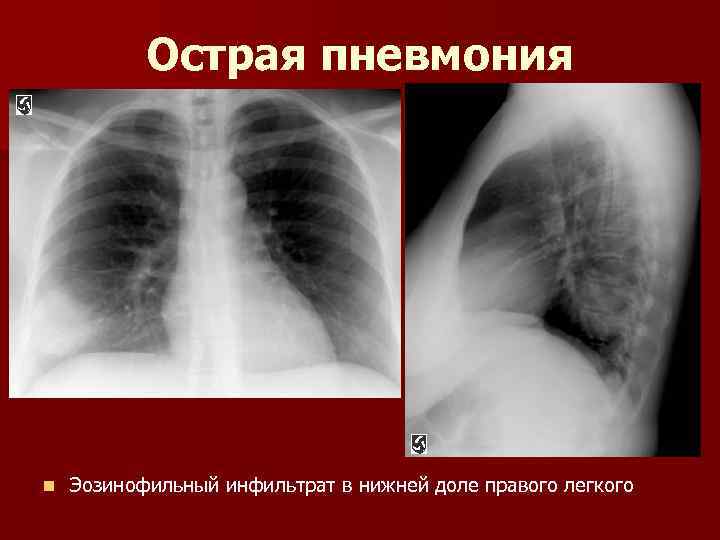 Пневмония в правом легком в нижней доле. Нижнедолевая пневмония справа рентген. Пневмония правой нижней доли. Пневмония правого Нижнего легкого.