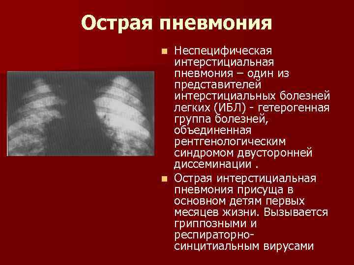 Острая пневмония Неспецифическая интерстициальная пневмония – один из представителей интерстициальных болезней легких (ИБЛ) -