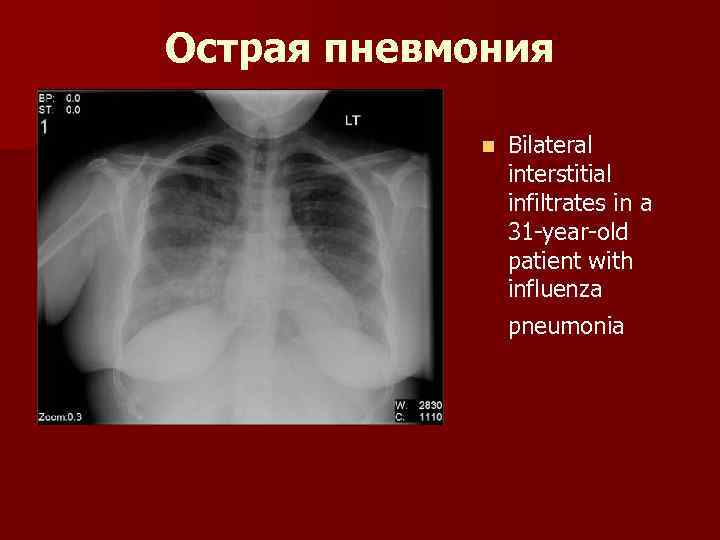 Острая пневмония n Bilateral interstitial infiltrates in a 31 -year-old patient with influenza pneumonia