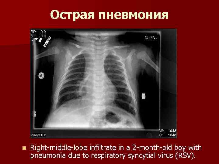 Острая пневмония n Right-middle-lobe infiltrate in a 2 -month-old boy with pneumonia due to