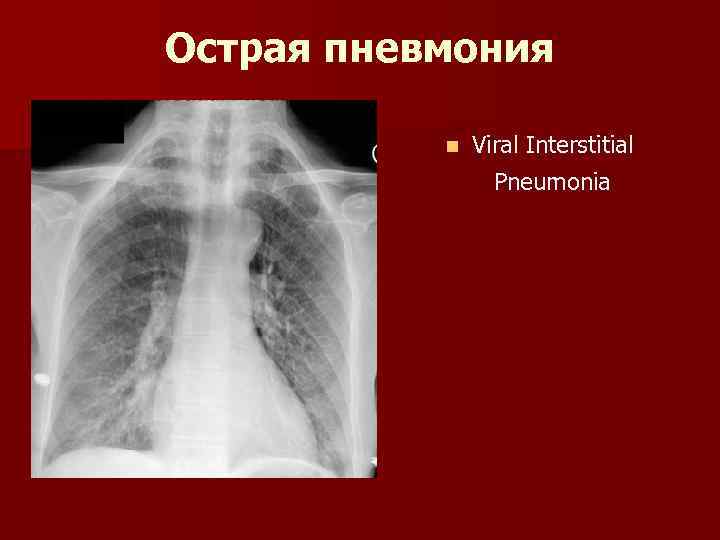 Острая пневмония n Viral Interstitial Pneumonia 