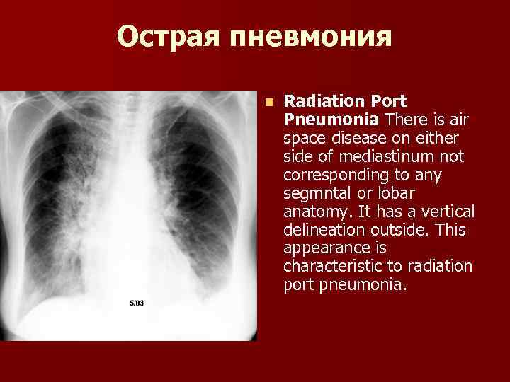 Острая пневмония. Острое воспаление лёгких. Острое воспаление легких. Рентгенодиагностика острых пневмоний.