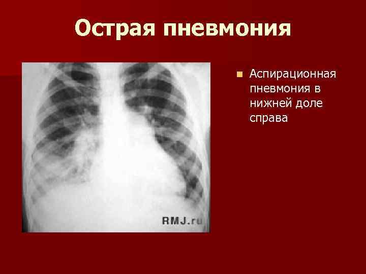 Острая пневмония n Аспирационная пневмония в нижней доле справа 