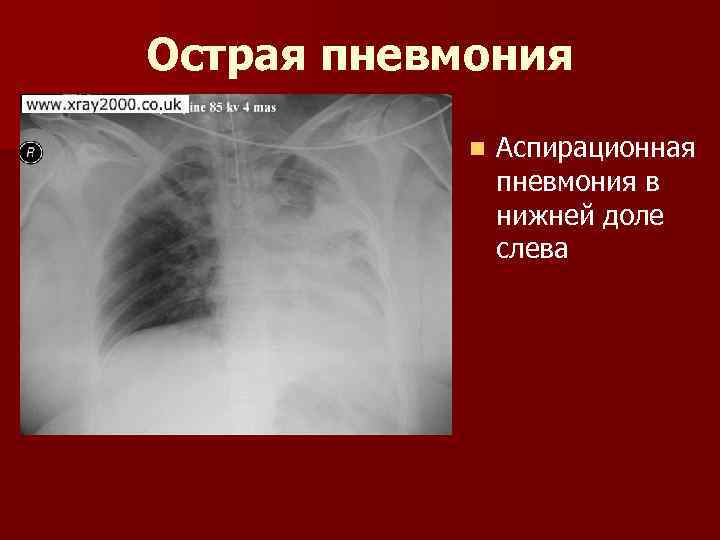 Острая пневмония n Аспирационная пневмония в нижней доле слева 