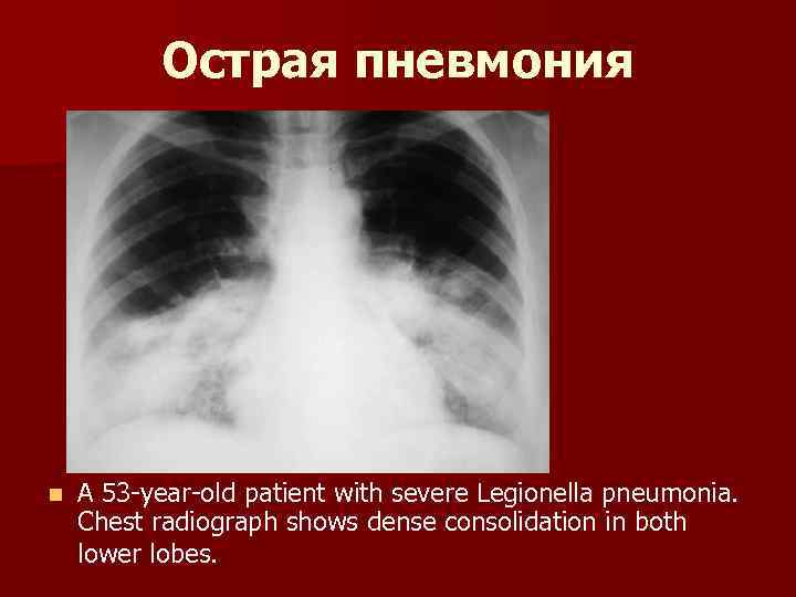 Острая пневмония n A 53 -year-old patient with severe Legionella pneumonia. Chest radiograph shows