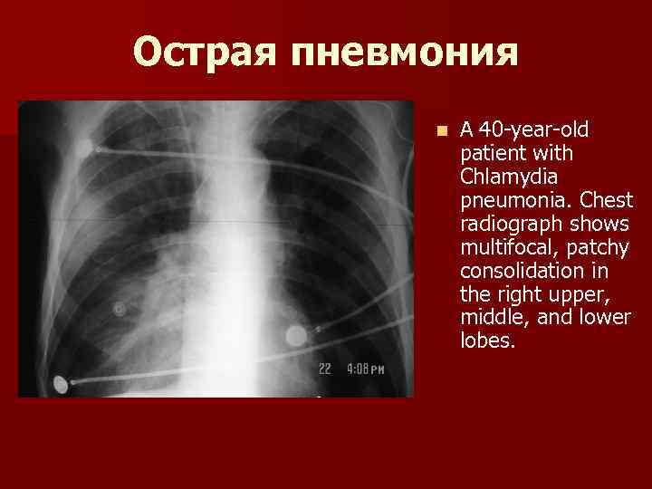 Острая пневмония n A 40 -year-old patient with Chlamydia pneumonia. Chest radiograph shows multifocal,