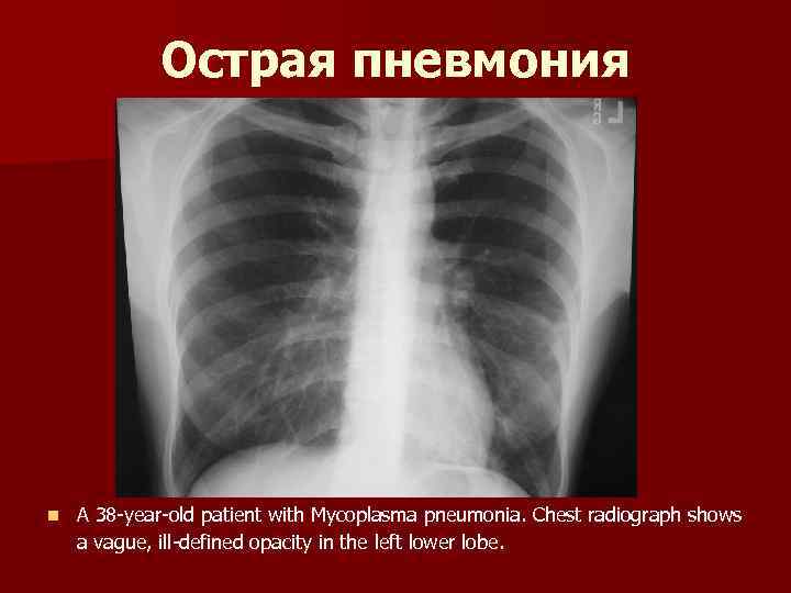 Острая пневмония n A 38 -year-old patient with Mycoplasma pneumonia. Chest radiograph shows a