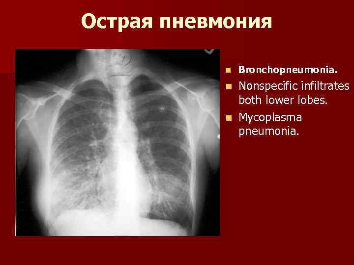 Острая пневмония n Bronchopneumonia. Nonspecific infiltrates both lower lobes. n Mycoplasma pneumonia. n 