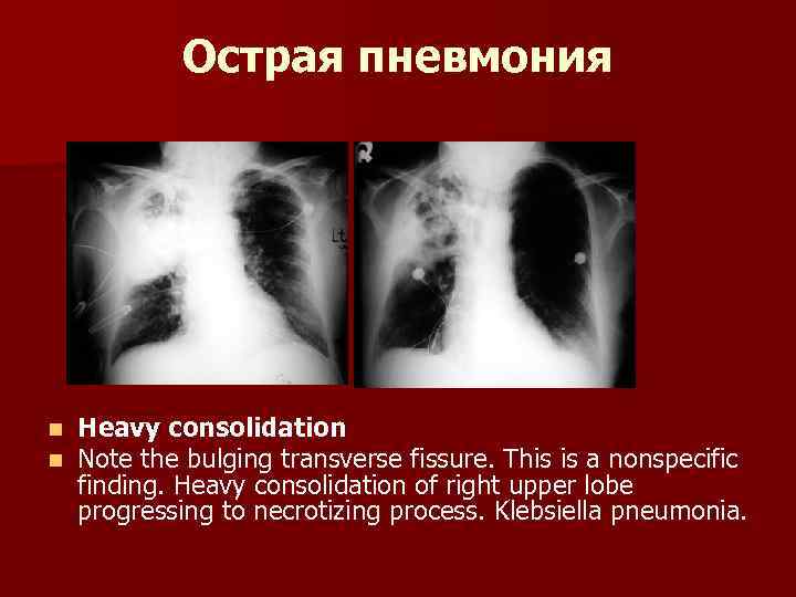 Острая пневмония n n Heavy consolidation Note the bulging transverse fissure. This is a