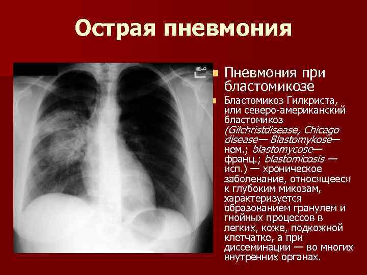 Острая пневмония n n Пневмония при бластомикозе Бластомикоз Гилкриста, или северо-американский бластомикоз (Gilchristdisease, Chicago