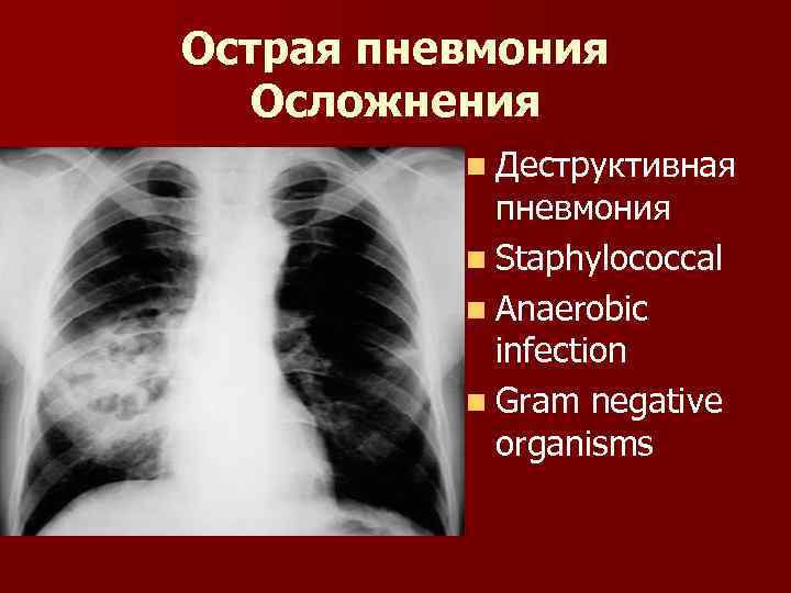 Острая пневмония Осложнения n Деструктивная пневмония n Staphylococcal n Anaerobic infection n Gram negative