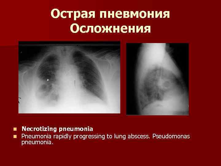 Острая пневмония Осложнения n n Necrotizing pneumonia Pneumonia rapidly progressing to lung abscess. Pseudomonas