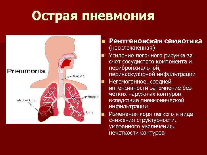 Острая пневмония n n Рентгеновская семиотика (неосложненная) Усиление легочного рисунка за счет сосудистого компонента