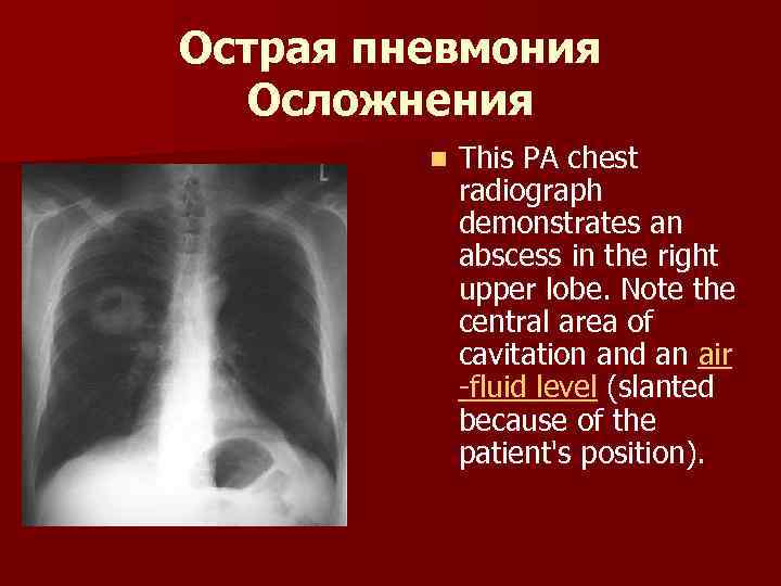 Острая пневмония Осложнения n This PA chest radiograph demonstrates an abscess in the right