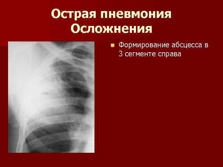 Острая пневмония Осложнения n Формирование абсцесса в 3 сегменте справа 