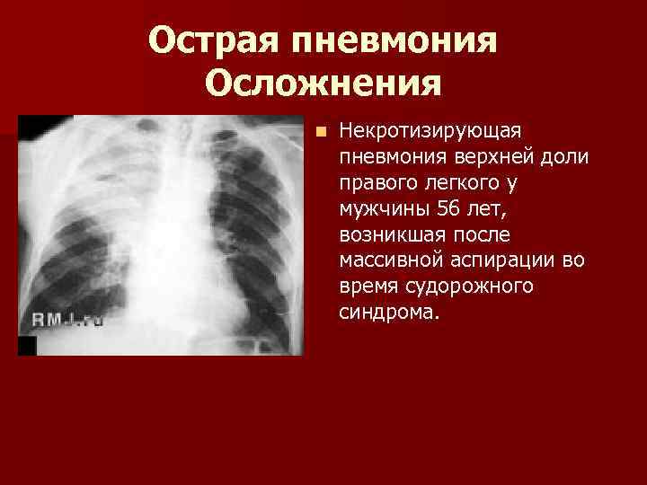 Острая пневмония Осложнения n Некротизирующая пневмония верхней доли правого легкого у мужчины 56 лет,