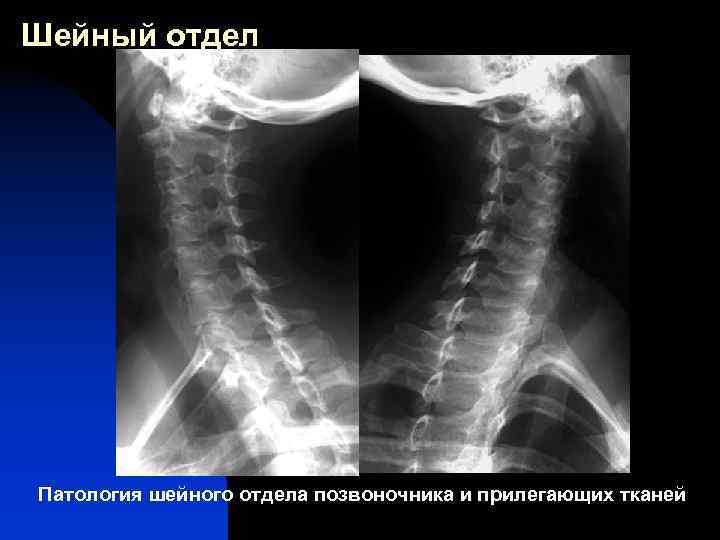 Mp картина дистрофических изменений шейного отдела позвоночника