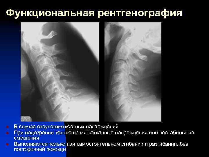 Функциональные пробы шейного отдела позвоночника