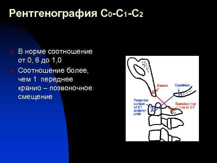 Рентгенография С 0 -С 1 -С 2 n n В норме соотношение от 0,