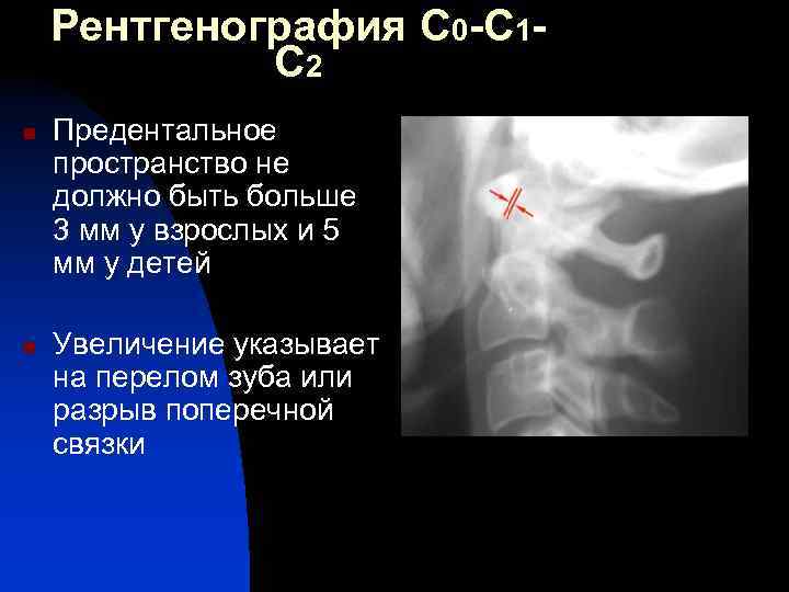Рентгенография С 0 -С 1 С 2 n n Предентальное пространство не должно быть