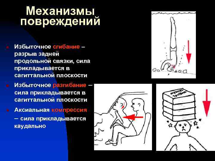 Механизмы повреждений n n n Избыточное сгибание – разрыв задней продольной связки, сила прикладывается