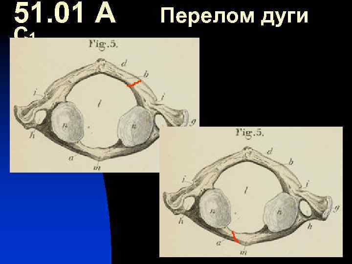 51. 01 А С 1 Перелом дуги 