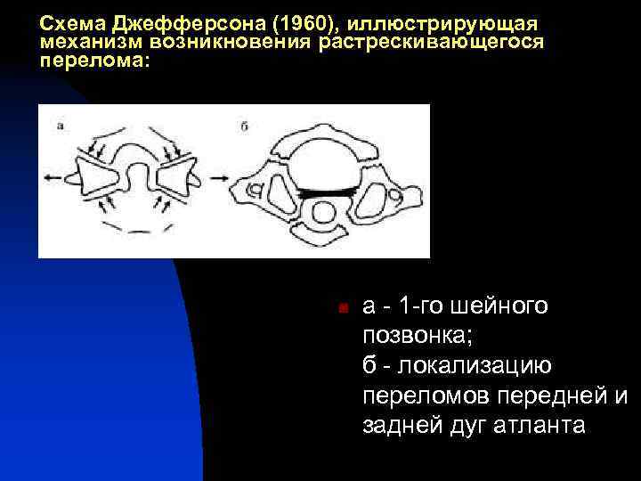 Схема Джефферсона (1960), иллюстрирующая механизм возникновения растрескивающегося перелома: n а - 1 -го шейного