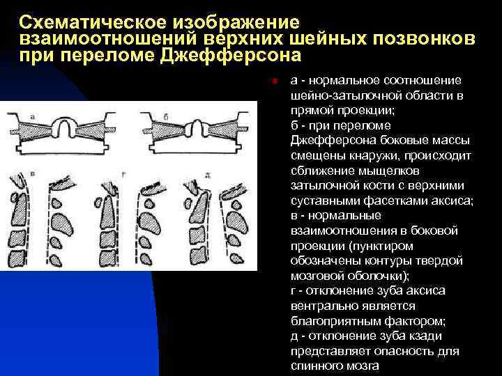 Схематическое изображение взаимоотношений верхних шейных позвонков при переломе Джефферсона n а - нормальное соотношение
