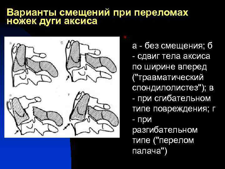 Варианты смещений при переломах ножек дуги аксиса n а - без смещения; б -