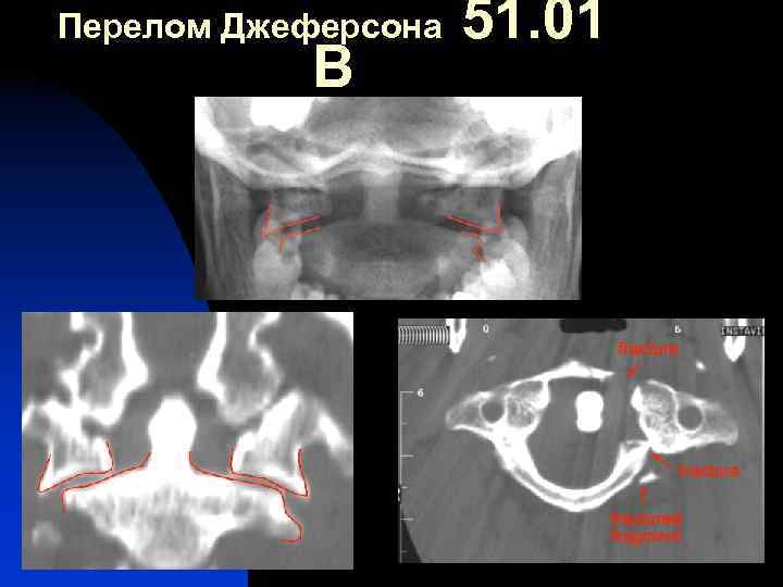 Перелом Джеферсона В 51. 01 