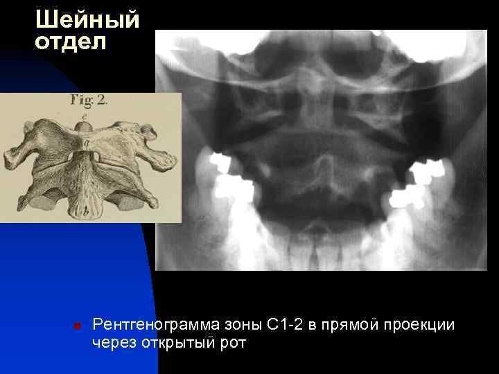 Аномалии шейного отдела позвоночника