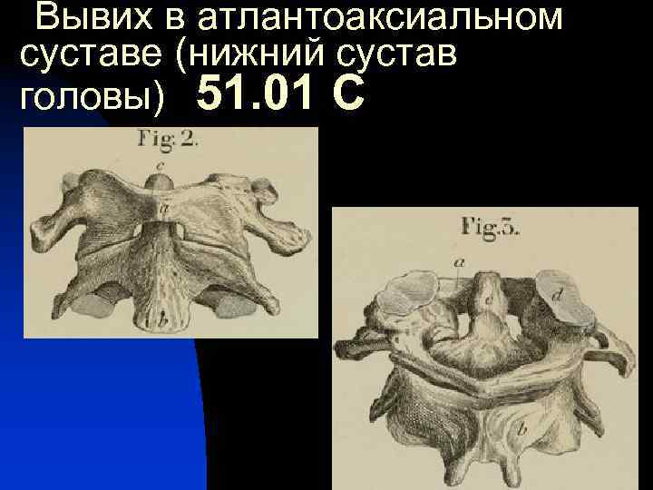  Вывих в атлантоаксиальном суставе (нижний сустав головы) 51. 01 С 