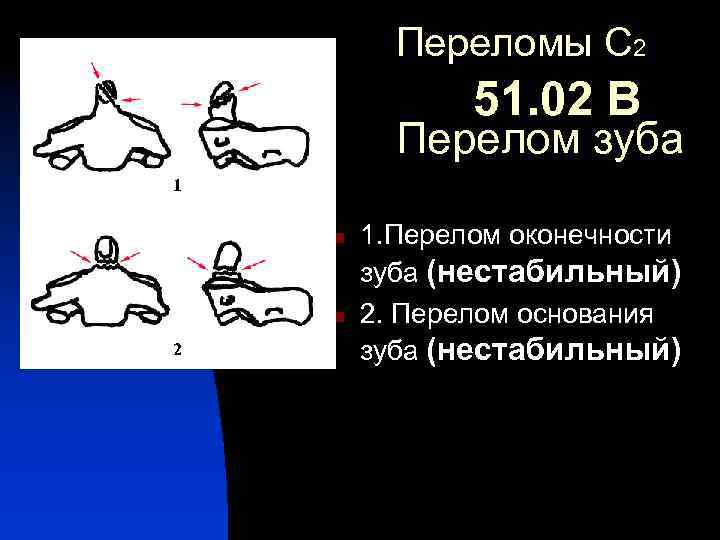 Переломы С 2 51. 02 В Перелом зуба 1. n n 2 1. Перелом