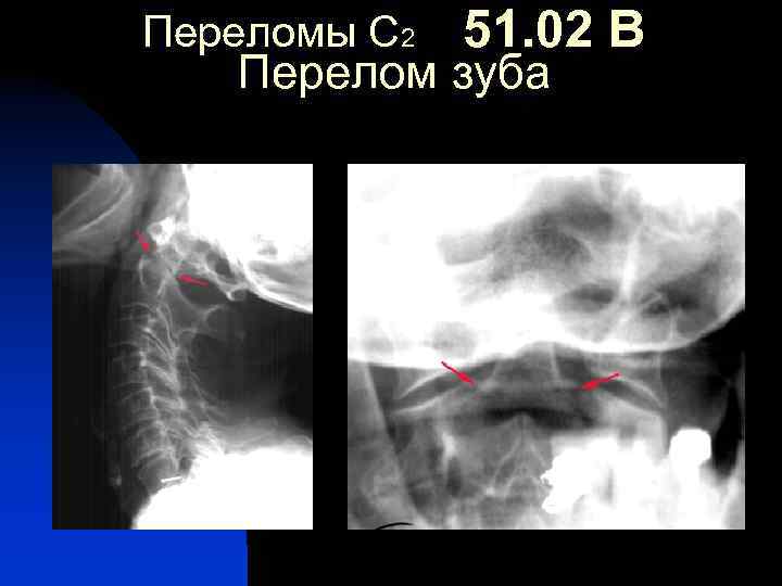 Переломы С 2 51. 02 В Перелом зуба 