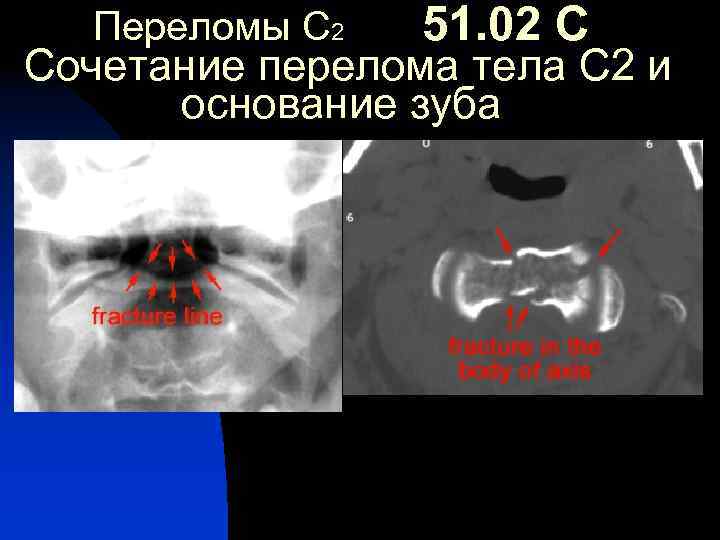Переломы С 2 51. 02 С Сочетание перелома тела С 2 и основание зуба