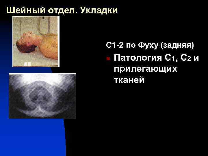 Шейный отдел. Укладки С 1 -2 по Фуху (задняя) n Патология С 1, С
