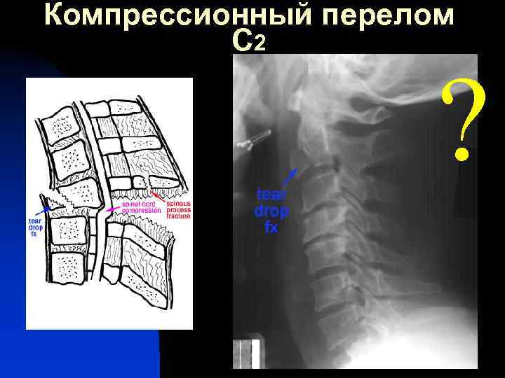 Компрессионный перелом С 2 ? 