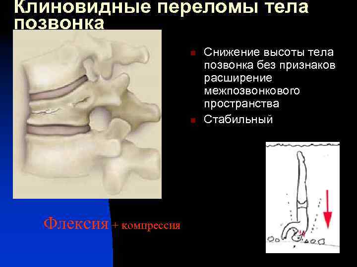 Снижение тел позвонков. Клиновидный компрессионный перелом позвоночника. Клиновидные компрессионные переломы тел позвонков. Клиновидный перелом тел позвонков. Компрессионный перелом позвоночника клиновидный передний.