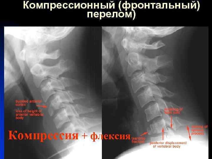 Компрессионный (фронтальный) перелом) Компрессия + флексия 