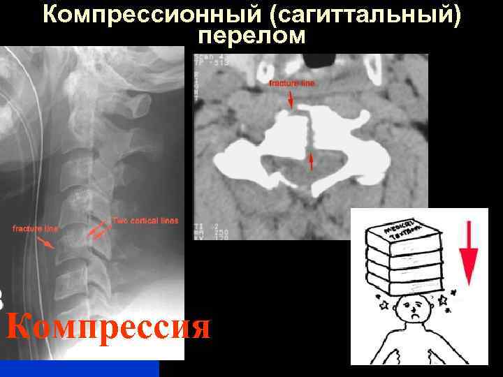 Компрессионный (сагиттальный) перелом Компрессия 
