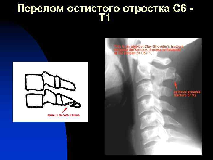 Перелом остистого отростка С 6 Т 1 