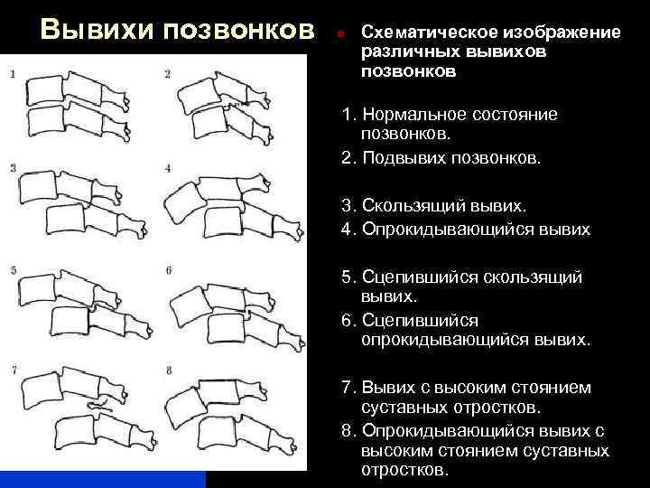 Вывих шейного позвонка карта вызова