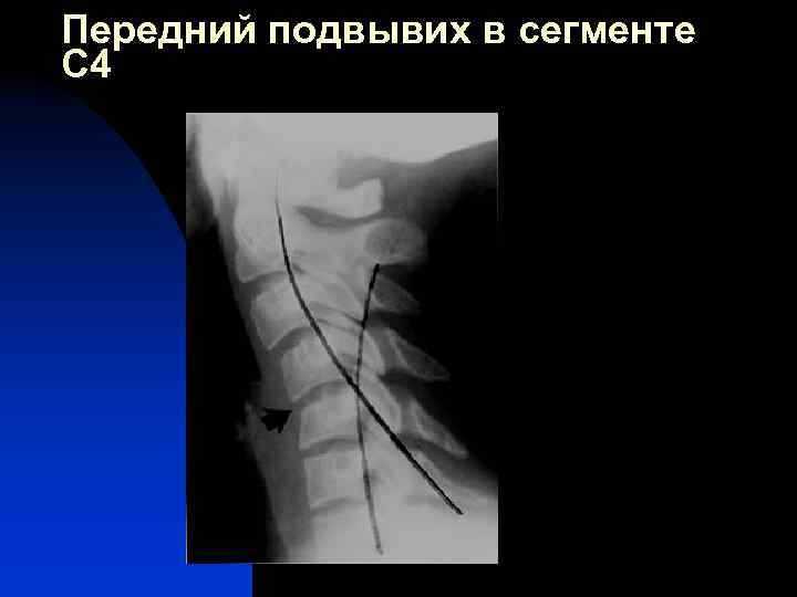 Передний подвывих в сегменте С 4 